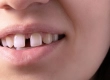 Gap Tooth Treatment: Costs, Veneers & Modern Solutions 2026
