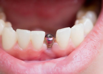 Lebensdauer des Implantats: Wie lange halten sie wirklich?
