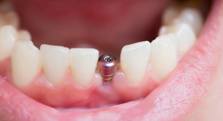 Lebensdauer des Implantats: Wie lange halten sie wirklich?