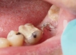 Is Infection After Tooth Extraction Normal?