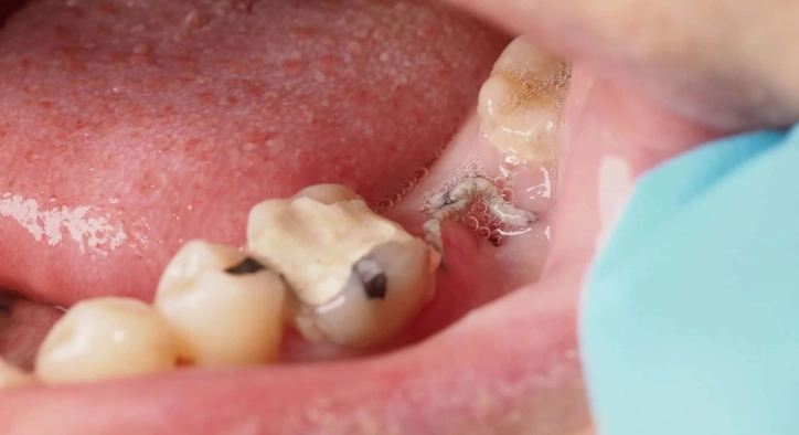 Is Infection After Tooth Extraction Normal?