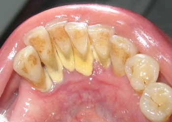 Wie entfernt man Zahnstein von den Zähnen?