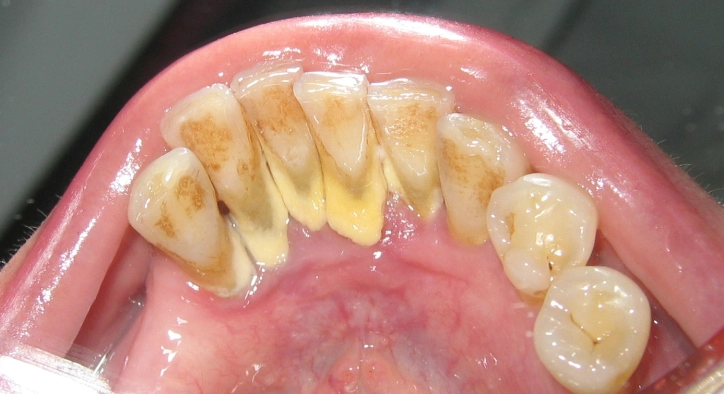 Wie entfernt man Zahnstein von den Zähnen?