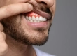 Abscess on Gum: Symptoms, Causes and Emergency Treatments