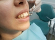 Buck Teeth Causes, Risks and Modern Correction Methods