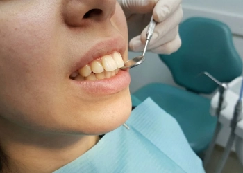Buck Teeth Causes, Risks and Modern Correction Methods