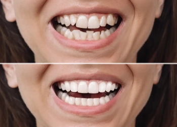 How Is Composite Bonding Applied? What Are Its Advantages?