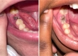 Healthy Socket After Extraction: What is the Recovery Process Like?