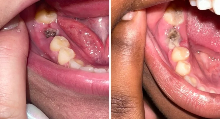 Healthy Socket After Extraction: What is the Recovery Process Like?