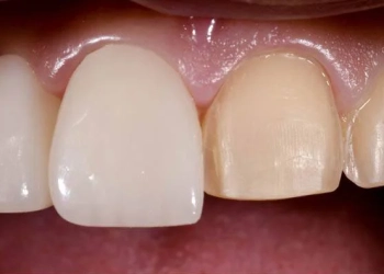 Laminate Teeth Veneer: Procedure, Benefits & Costs 2026