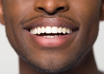 Teeth Whitening Turkey: Professional Laser Smile Guide