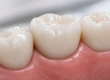 Screwless Dental Implants: Cost, Benefits & Turkey Guide