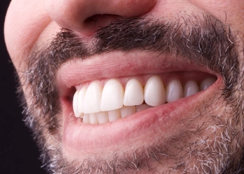 Deep Bite Causes, Symptoms and Correction Options