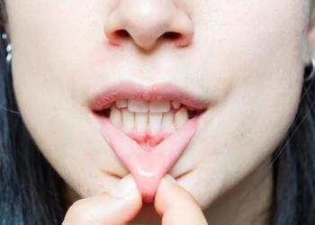What Causes Gum Recession? How Is It Treated?