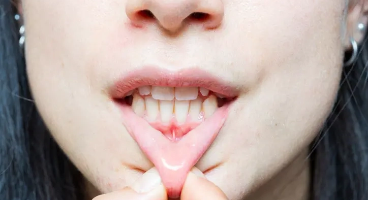 What Causes Gum Recession? How Is It Treated?