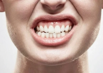 Bruxism Symptoms, Causes & Modern Treatments