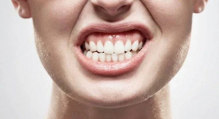 Bruxism Symptoms, Causes & Modern Treatments