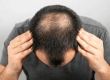 Fehlgeschlagene Haartransplantation: Ursachen & Korrektur