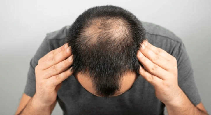 Fehlgeschlagene Haartransplantation: Ursachen & Korrektur