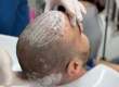 Welche Vorsichtsmaßnahmen sollten nach einer Haartransplantation getroffen werden?