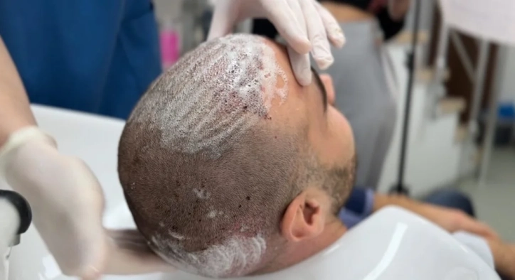 Welche Vorsichtsmaßnahmen sollten nach einer Haartransplantation getroffen werden?