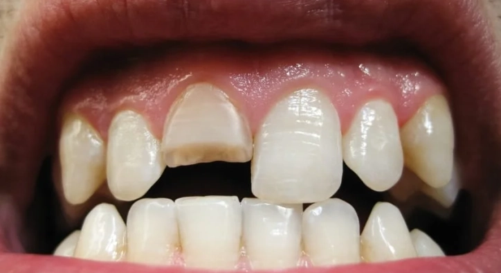 Cracked Teeth Causes, Repair Options & Treatments
