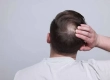 Crown Hair Transplant Costs, Results & Turkey Guide
