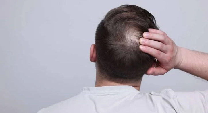 Crown Hair Transplant Costs, Results & Turkey Guide