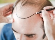 How Is a Forehead Hair Transplant Performed?