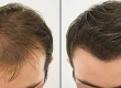 Hair Transplant Before and After: Real Growth Transformations