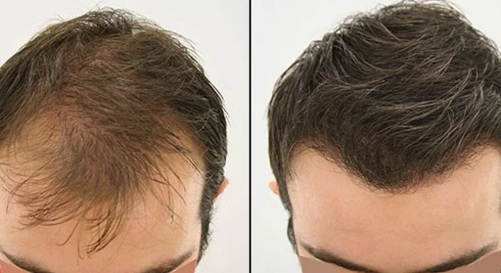 Hair Transplant Before and After: Real Growth Transformations