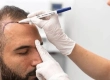 Kosten für eine Haartransplantation 2026: Preise & Pakete