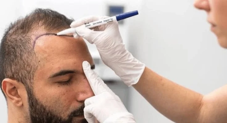 Kosten für eine Haartransplantation 2026: Preise & Pakete