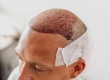 Haartransplantation in der Türkei: Der umfassende klinische Leitfaden zu den besten Methoden, Kosten und All-inclusive-Paketen