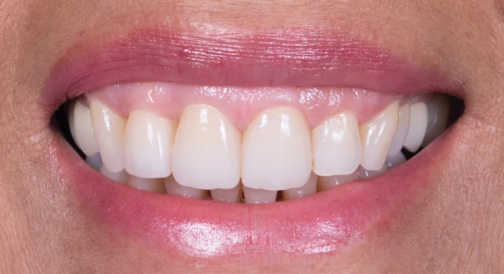 Was Ist Monolithisches Zirkonoxid-Veneer? Für Wen Ist Es Geeignet?
