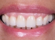 What Is Monolithic Zirconia Veneer? Who Is It Suitable For?
