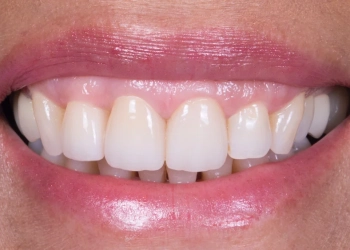 What Is Monolithic Zirconia Veneer? Who Is It Suitable For?