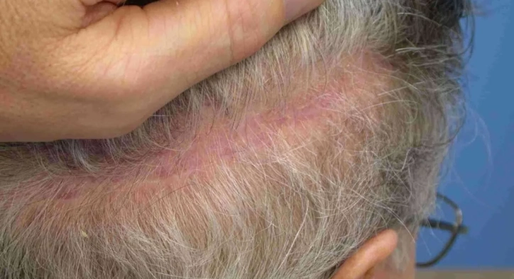 Was Verursacht Shock Loss Nach Einer Haartransplantation? Bildet Er Sich Von Selbst Zurück?