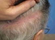 What Causes Shock Loss After a Hair Transplant? Does It Resolve On Its Own?
