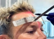 How Is Unshaven Hair Transplant Performed? Does It Work?