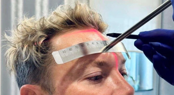 How Is Unshaven Hair Transplant Performed? Does It Work?