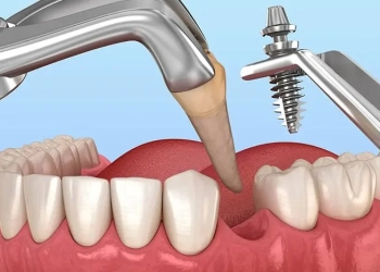 What Are Immediate Implants? Who Are They Suitable For?