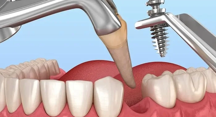 What Are Immediate Implants? Who Are They Suitable For?