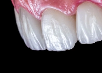 What Are Non Prep Veneers? Procedure And Cost