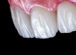 Was Sind Non-Prep-Veneers? Verfahren und Kosten