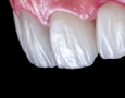 Was Sind Non-Prep-Veneers? Verfahren und Kosten