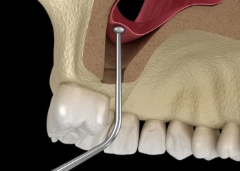 Why Is Sinus Lift Surgery Performed? Recovery Process