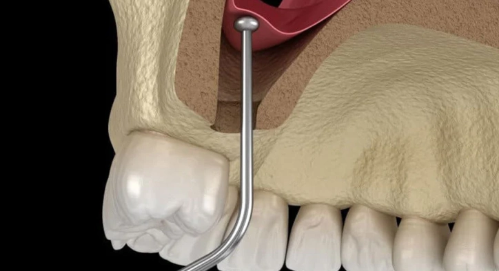 Why Is Sinus Lift Surgery Performed? Recovery Process