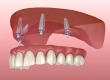 What Are All-On-4 Dental Implants and In Which Situations Are They Preferred?