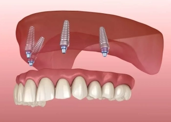 What Are All-On-4 Dental Implants and In Which Situations Are They Preferred?